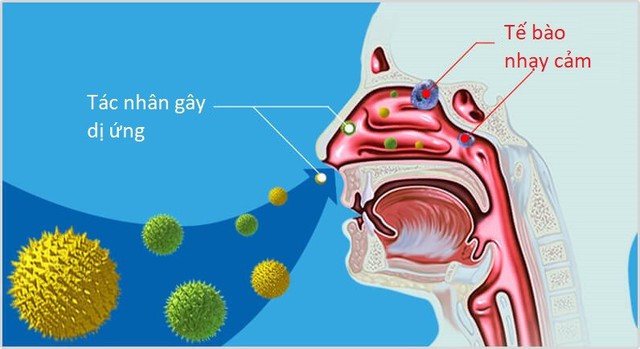 Cách chữa bệnh viêm mũi dị ứng thời tiết đơn giản